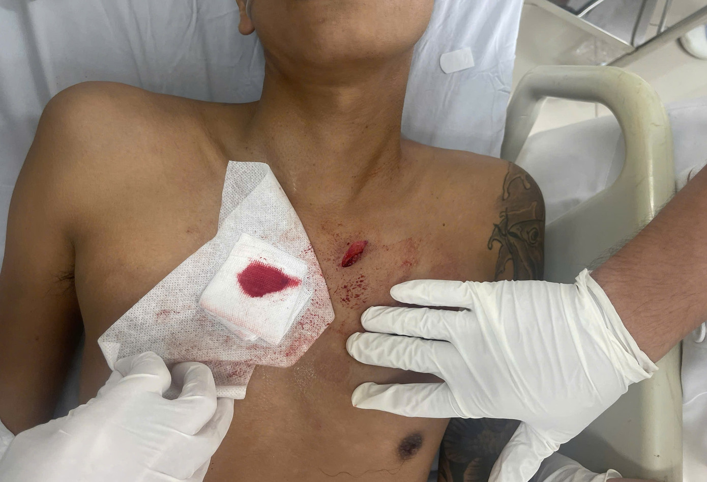 Vết thương hở ở vùng ngực trái của người bệnh thời điểm vào viện cấp cứu