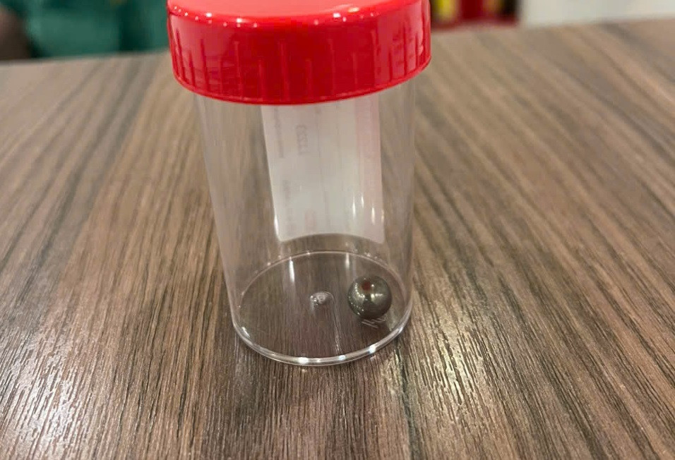 Viên bi đã bắn vào cơ thể của trẻ gây ra những thương tích nghiêm trọng Viên bi đã bắn vào cơ thể của trẻ gây ra những thương tích nghiêm trọng