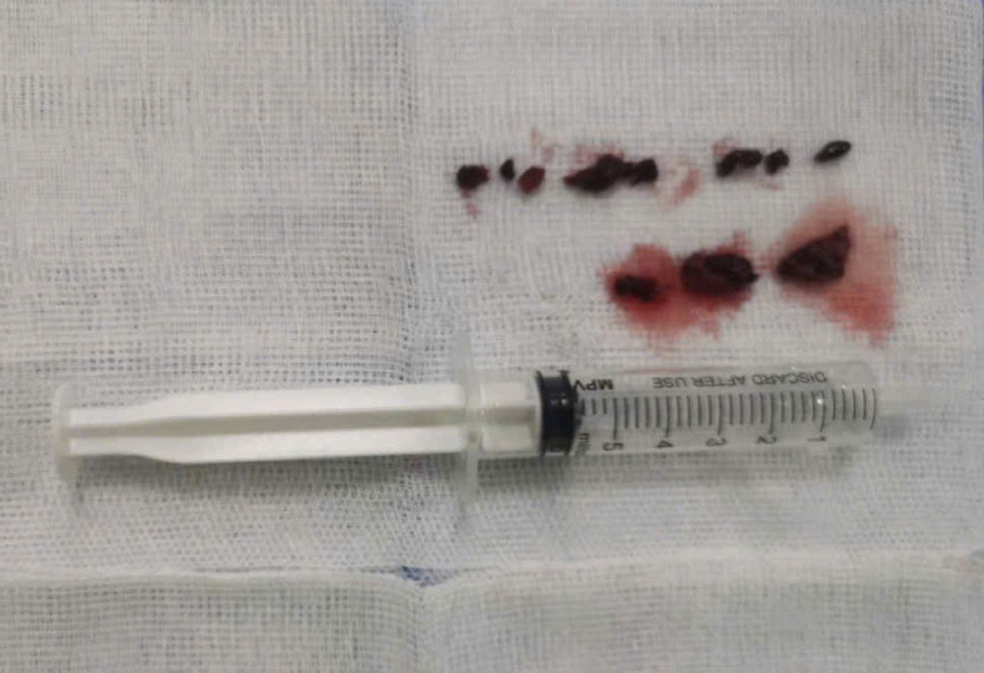 Các cục huyết khối là nguyên nhân gây tắc tĩnh mạch chậu - đùi được lấy ra khỏi cơ thể bệnh nhân Các cục huyết khối là nguyên nhân gây tắc tĩnh mạch chậu - đùi được lấy ra khỏi cơ thể bệnh nhân