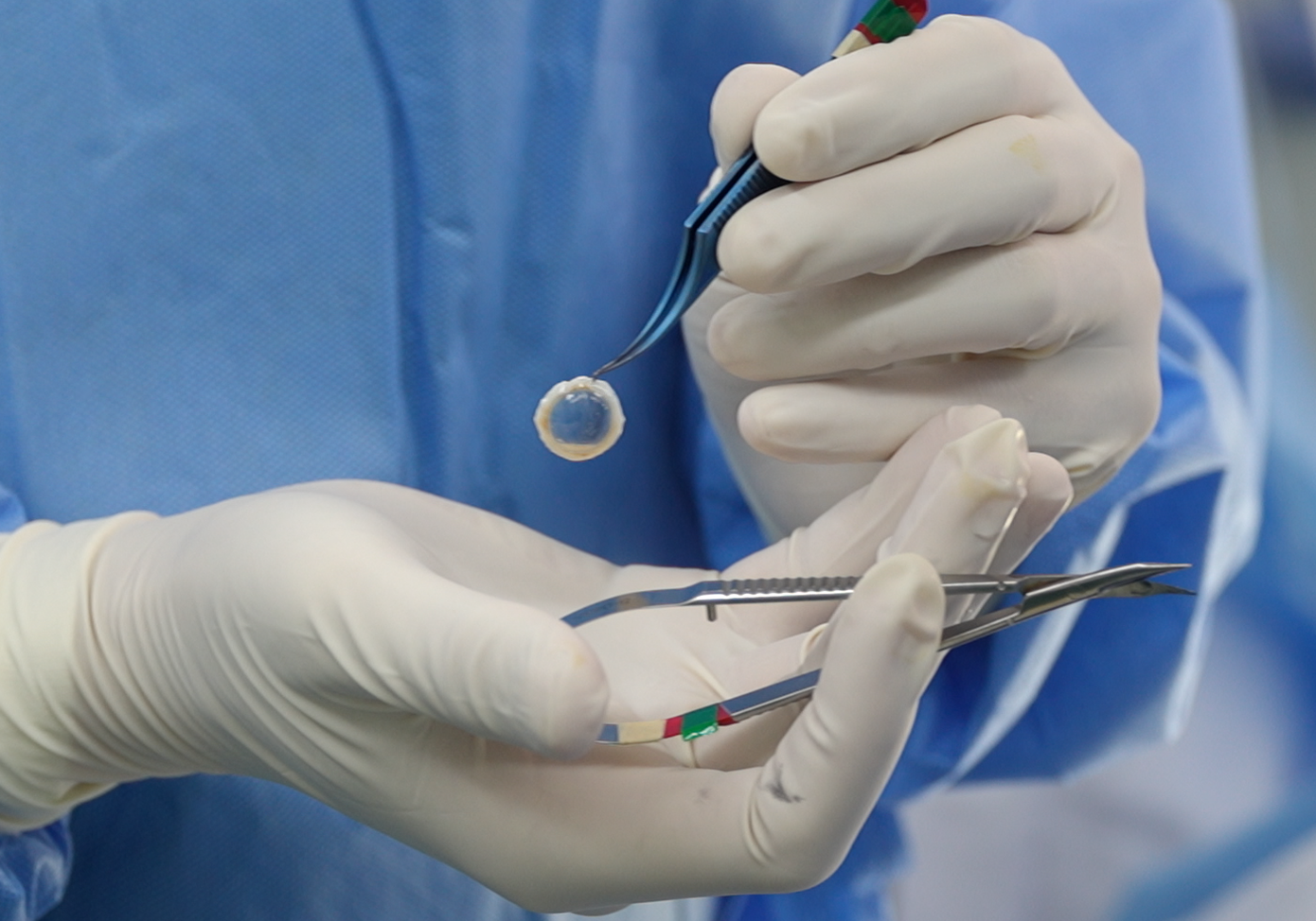 Bác sĩ nâng niu giác mạc được tiếp nhận từ người hiến chết não Bác sĩ nâng niu giác mạc được tiếp nhận từ người hiến chết não