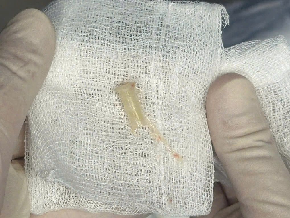 Dị vật được các bác sĩ thực hiện thủ thuật lấy ra từ đường thở của bệnh nhi Dị vật được các bác sĩ thực hiện thủ thuật lấy ra từ đường thở của bệnh nhi