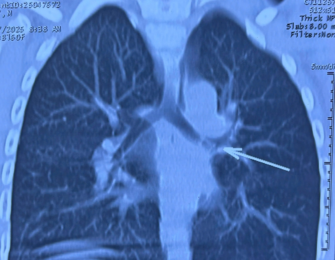 Dị vật nằm trong đường thở của bệnh nhi được phát hiện qua hình ảnh kiểm tra Dị vật nằm trong đường thở của bệnh nhi được phát hiện qua hình ảnh kiểm tra