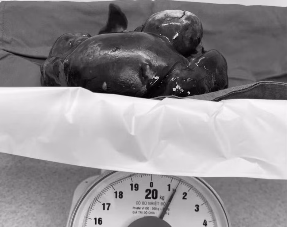 Lá lách to gấp 40 bình thường đã được bác sĩ cắt trọn khỏi cơ thể người bệnh Lá lách to gấp 40 bình thường đã được bác sĩ cắt trọn khỏi cơ thể người bệnh