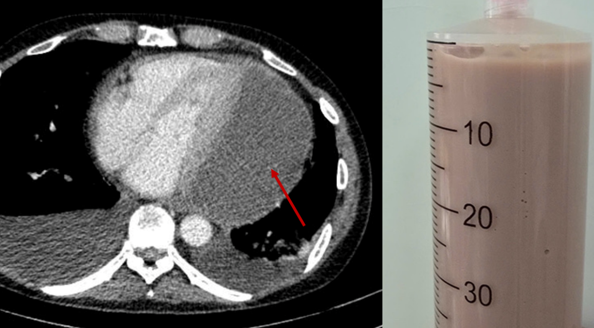 Các bác sĩ đã hút ra rất nhiều mủ đang bóp nghẹt trái tim giúp bệnh nhân qua nguy kịch