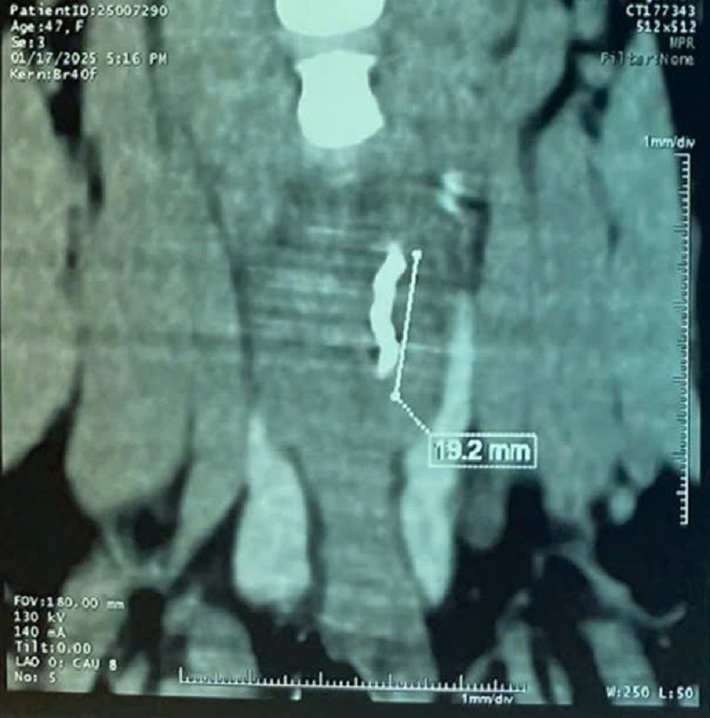 Dị vật là mảnh kim loại nằm ở vị trí rất khó phát hiện được nhìn thấy trên hình ảnh kiểm tra Dị vật là mảnh kim loại nằm ở vị trí rất khó phát hiện được nhìn thấy trên hình ảnh kiểm tra