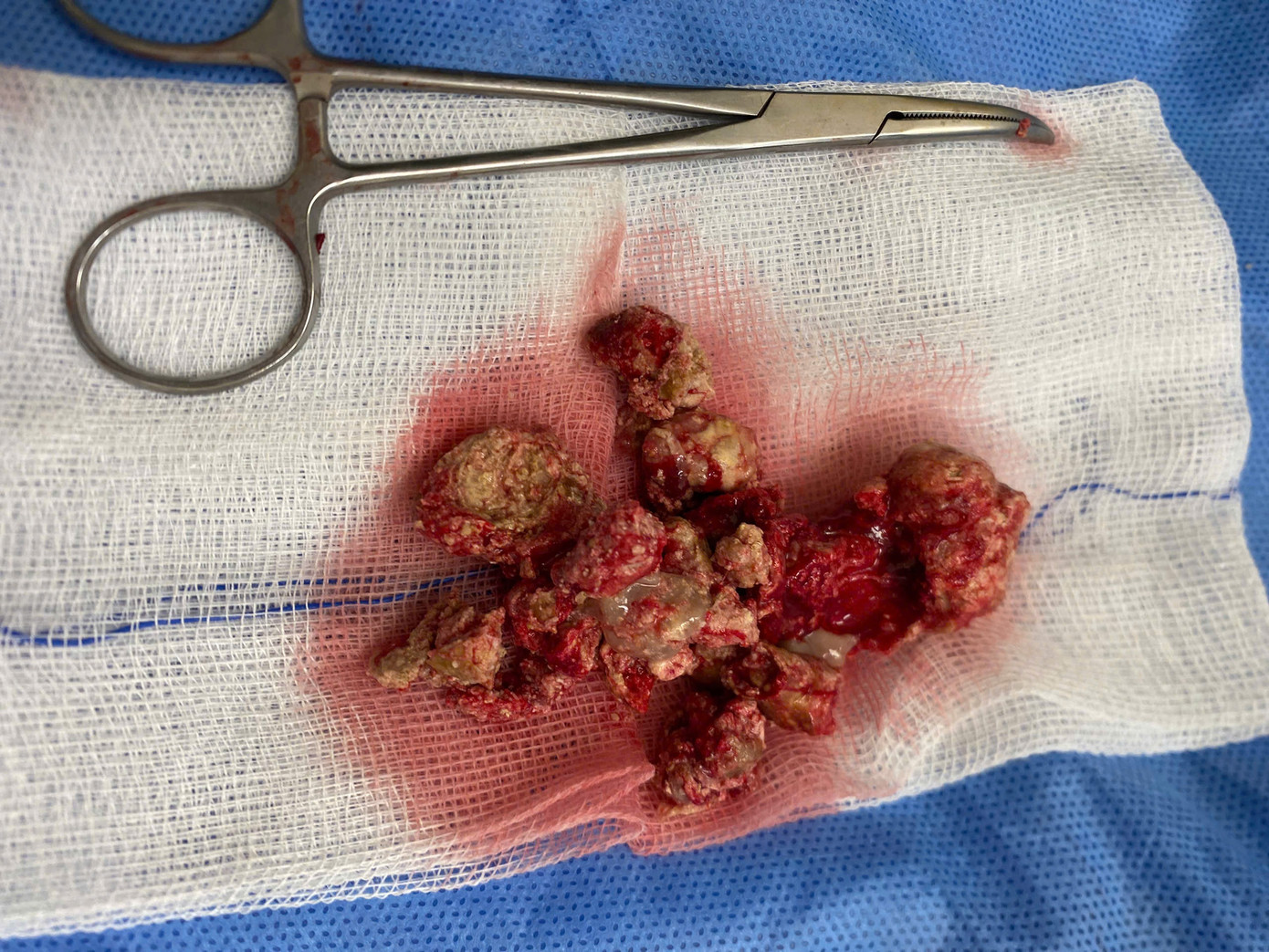 Hàng chục viên sỏi san hô được ê kíp bác sĩ loại bỏ khỏi cơ thể người bệnh Hàng chục viên sỏi san hô được ê kíp bác sĩ loại bỏ khỏi cơ thể người bệnh