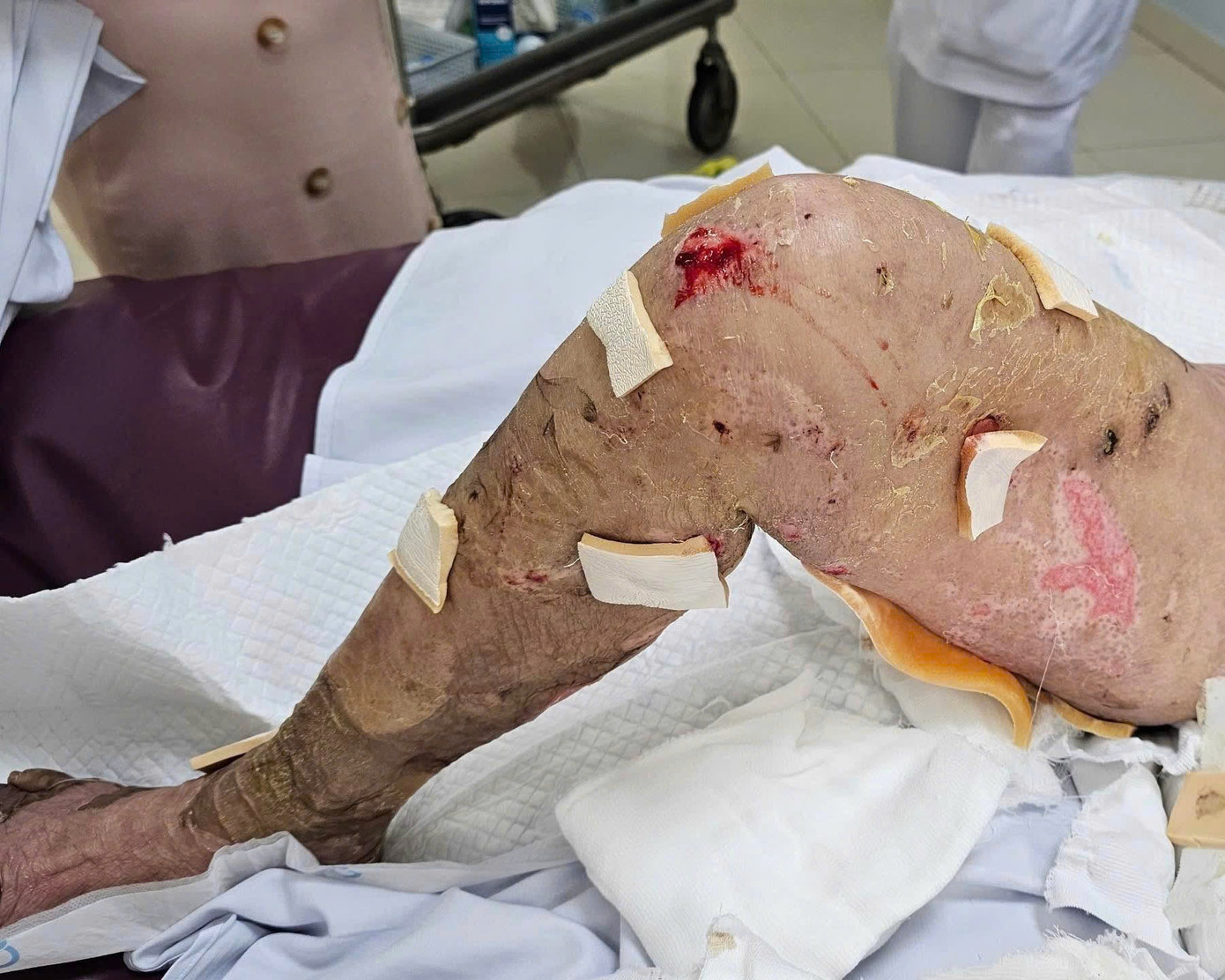 Bệnh nhân bị tổn thương da nghiêm trọng sau khi sử dụng kháng sinh vì hội chứng Lyell