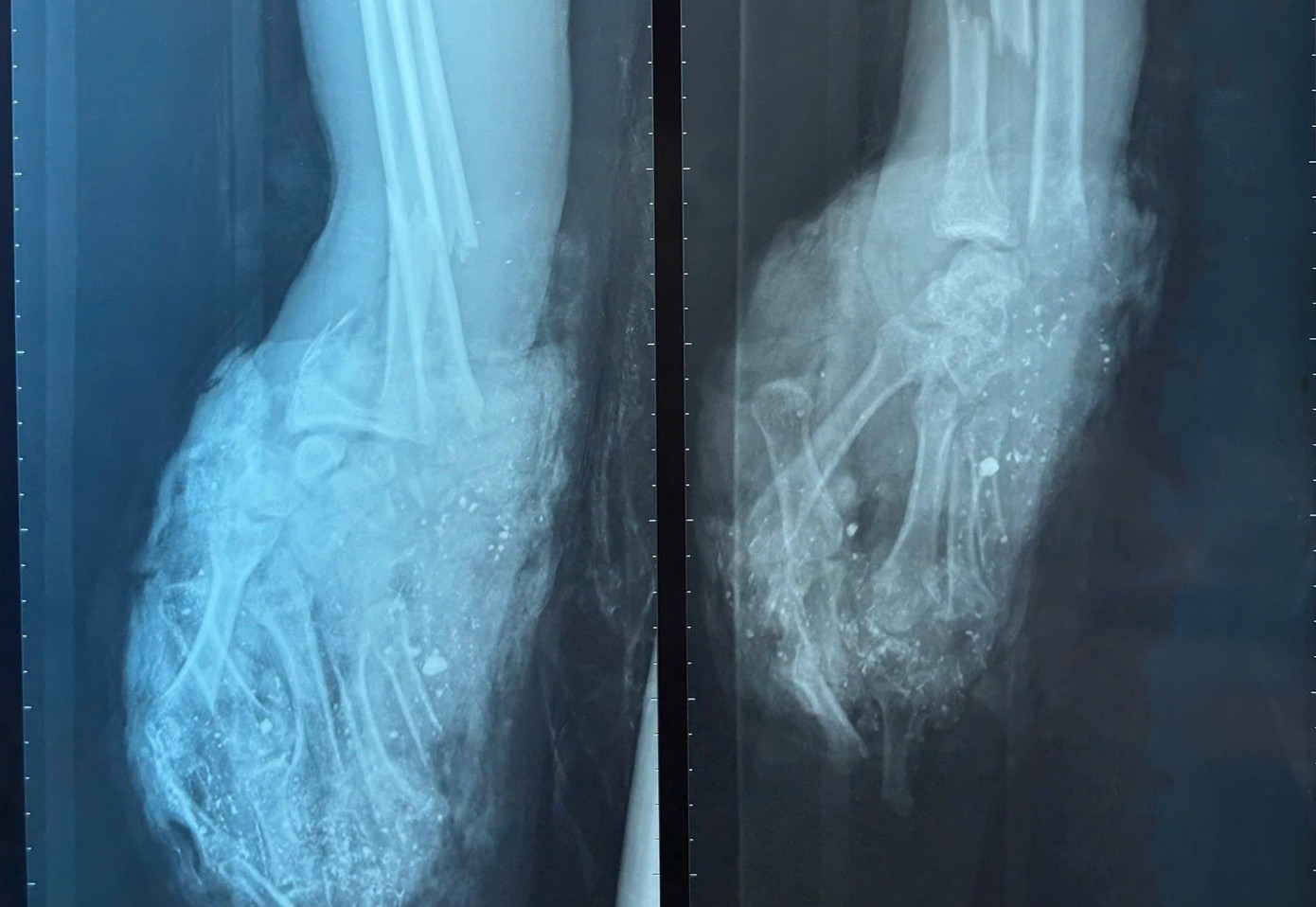 Bàn tay phải của bệnh nhân dập nát không còn khả năng điều trị bảo tồn Bàn tay phải của bệnh nhân dập nát không còn khả năng điều trị bảo tồn