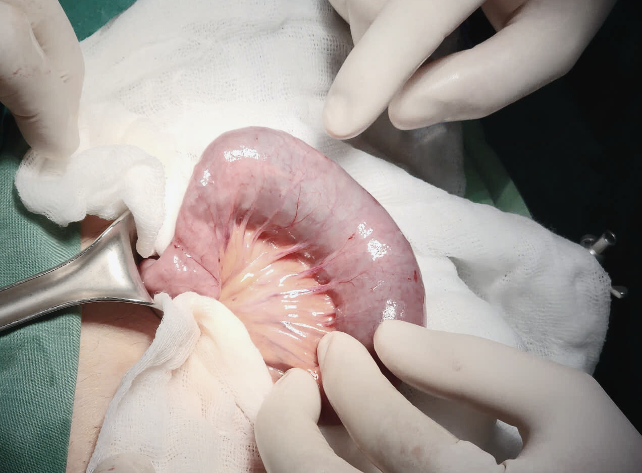 Trong quá trình phẫu thuật, bác sĩ phát hiện ruột bệnh nhân bị tắc có chứa nhiều bã thức ăn Trong quá trình phẫu thuật, bác sĩ phát hiện ruột bệnh nhân bị tắc có chứa nhiều bã thức ăn