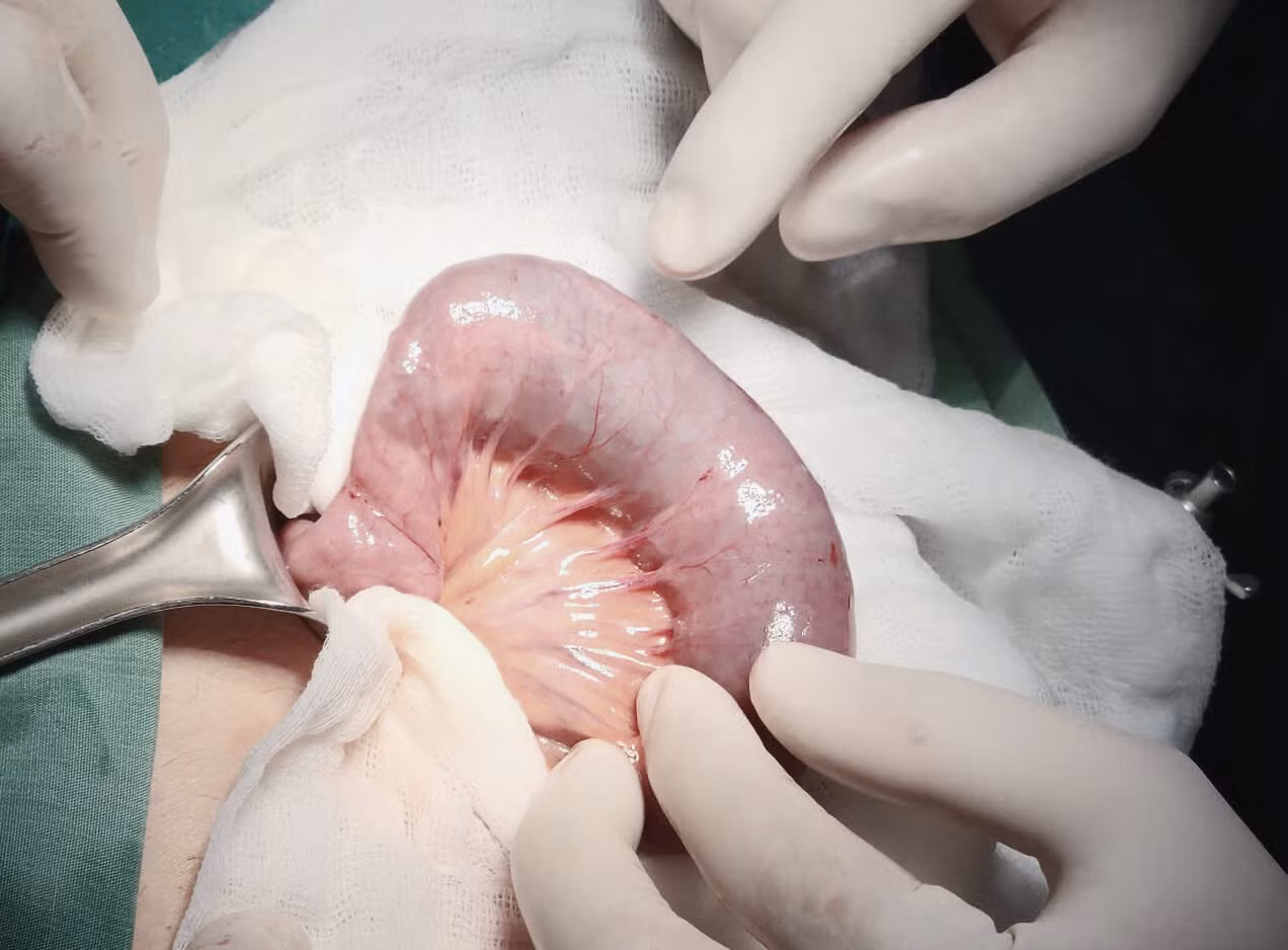 Trong quá trình phẫu thuật, bác sĩ phát hiện ruột bệnh nhân bị tắc có chứa nhiều bã thức ăn