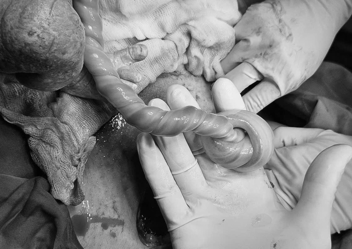 Dây rốn bị thắt nút là nguyên nhân khiến thai nhi có biểu hiện suy thai trong bụng mẹ Dây rốn bị thắt nút là nguyên nhân khiến thai nhi có biểu hiện suy thai trong bụng mẹ