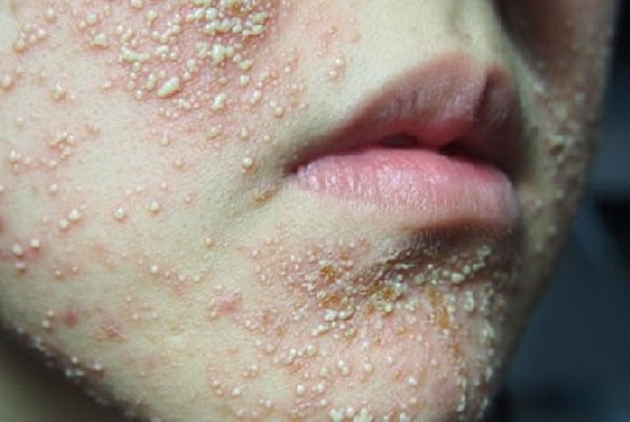 Rất nhiều người đã trở thành nạn nhân của loại kem trộn chứa các hóa chất độc hại