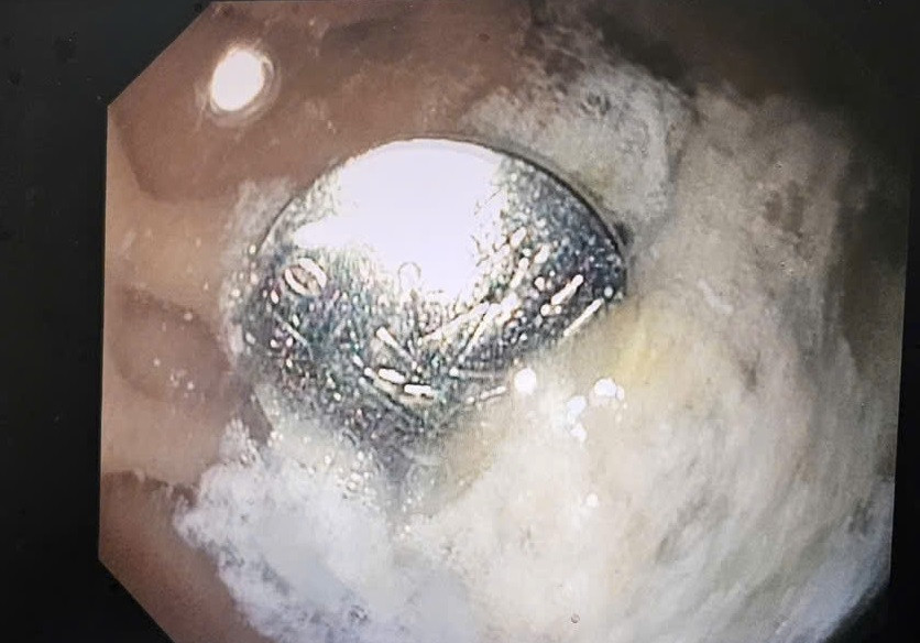 Cục pin được phát hiện nằm trong dạ dày của bệnh nhi trên hình ảnh nội soi Cục pin được phát hiện nằm trong dạ dày của bệnh nhi trên hình ảnh nội soi