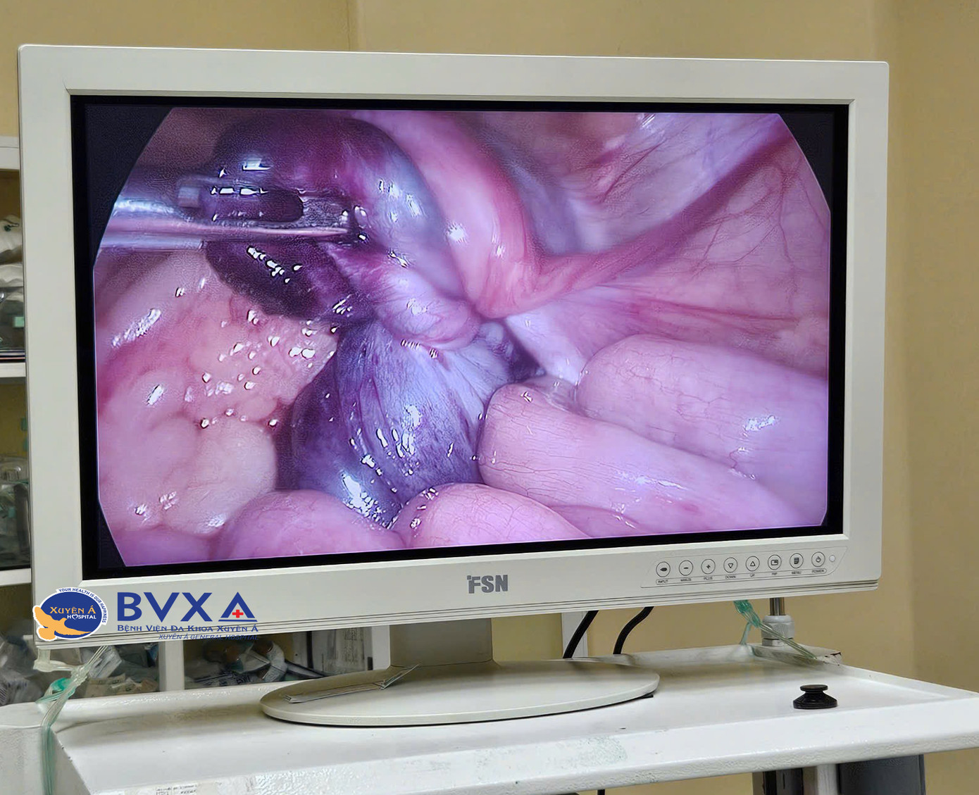 Các bác sĩ đã thực hiện cuộc phẫu thuật nội soi, cắt buồng trứng đã bị hoại tử cho bệnh nhi Các bác sĩ đã thực hiện cuộc phẫu thuật nội soi, cắt buồng trứng đã bị hoại tử cho bệnh nhi