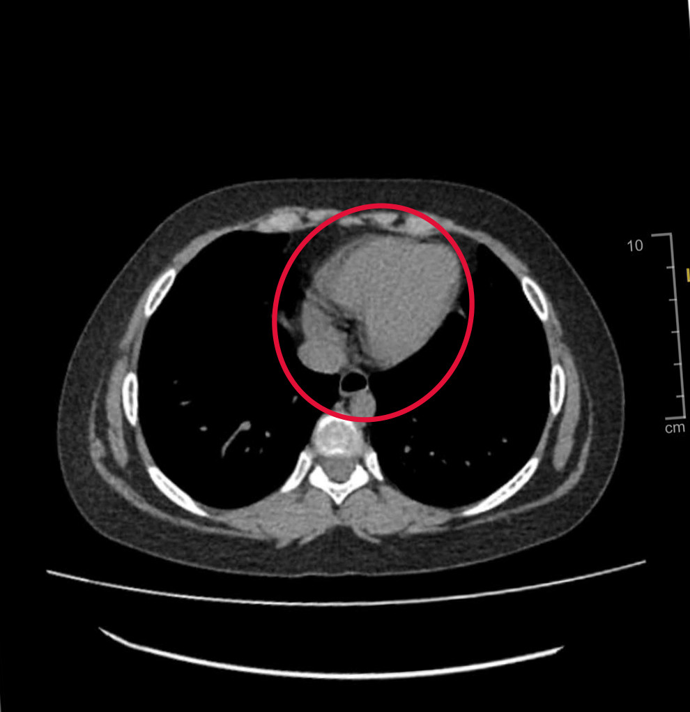 Hình ảnh kiểm tra phát hiện khối u khiến buồng trứng của bệnh nhi bị xoắn nhiều vòng Hình ảnh kiểm tra phát hiện khối u khiến buồng trứng của bệnh nhi bị xoắn nhiều vòng