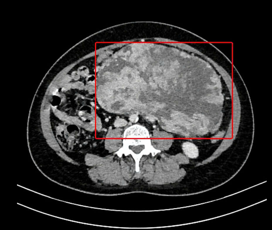 Hình ảnh kiểm tra ghi nhận khối u có kích thước rất lớn chiếm gần trọn thể tích ổ bụng bệnh nhân Hình ảnh kiểm tra ghi nhận khối u có kích thước rất lớn chiếm gần trọn thể tích ổ bụng bệnh nhân
