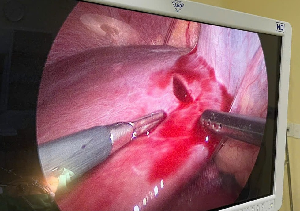 Hình ảnh camera khi các bác sĩ tiến hành nội soi cầm máu cho bệnh nhân