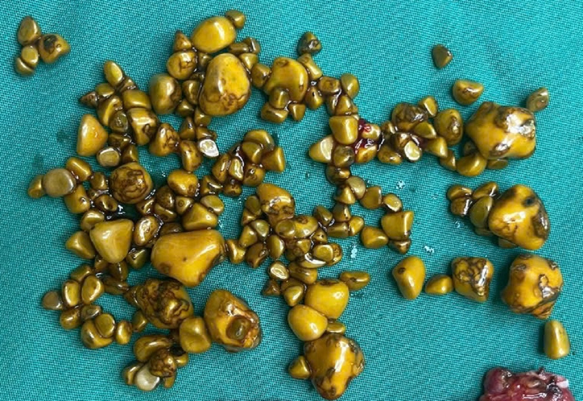 Hàng trăm viên sỏi lớn nhỏ khác nhau chất đầy trong túi mật của người bệnh Hàng trăm viên sỏi lớn nhỏ khác nhau chất đầy trong túi mật của người bệnh