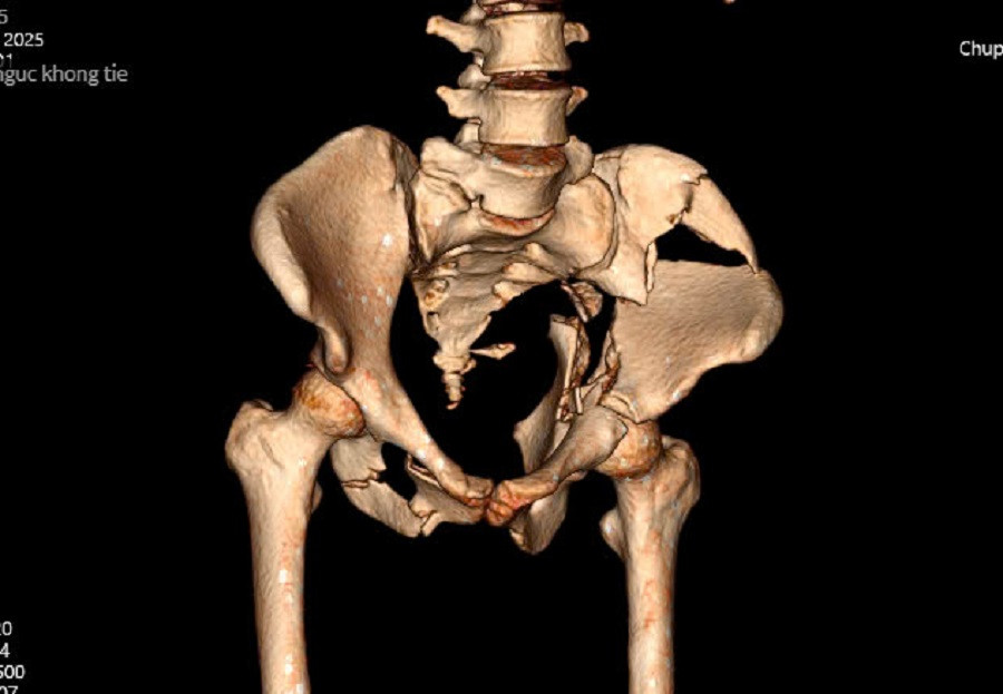 Hình ảnh kiểm tra cho thấy, vùng xương chậu của bệnh nhân bị dập nát nghiêm trọng Hình ảnh kiểm tra cho thấy, vùng xương chậu của bệnh nhân bị dập nát nghiêm trọng