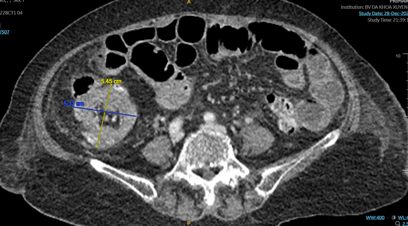 Hình ảnh CT cho thấy vị trí bất thường trong ổ bụng của người bệnh