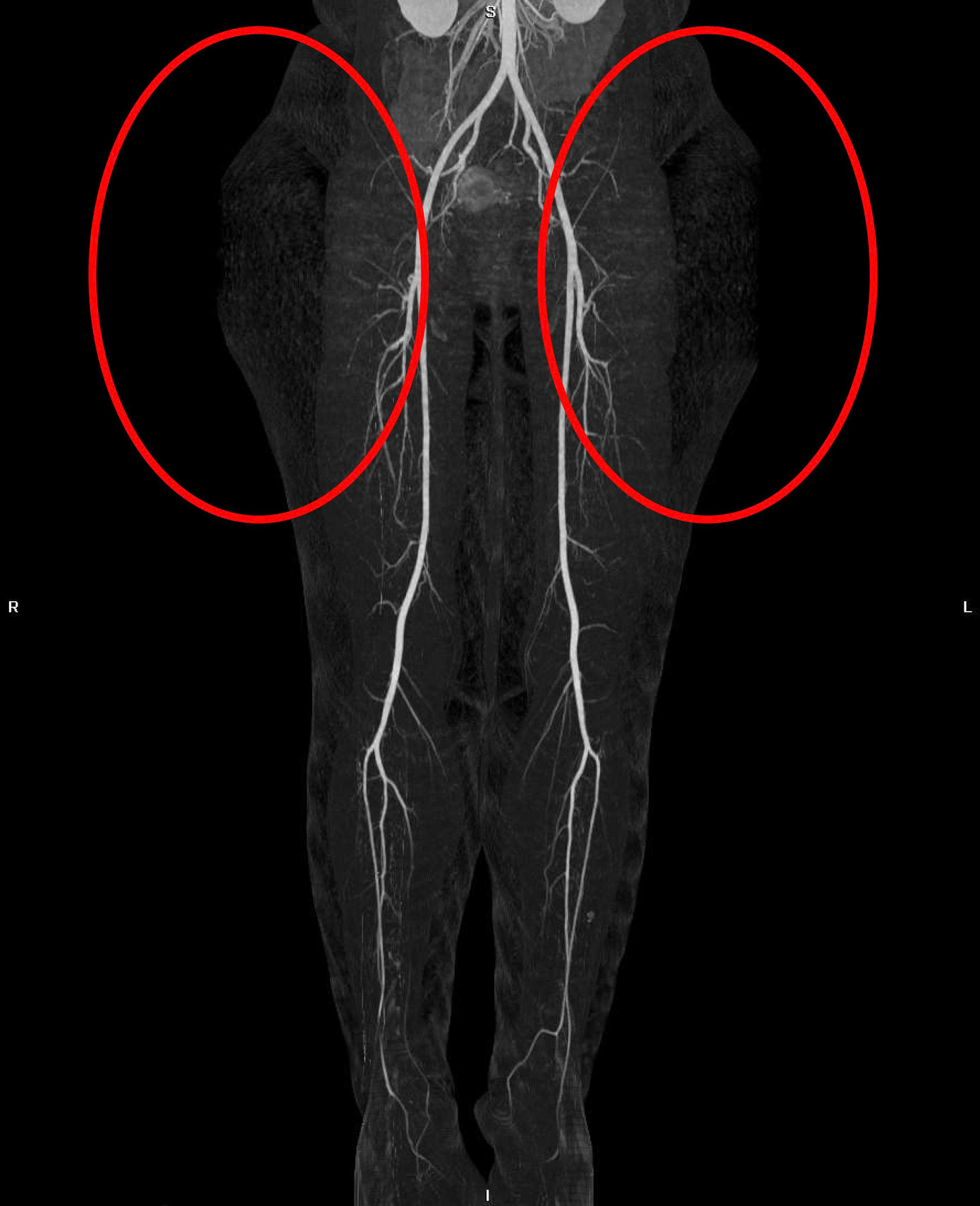 Hình ảnh kiểm tra ghi nhận 2 khối mỡ đối xứng ở vùng mông của nữ bệnh nhân Hình ảnh kiểm tra ghi nhận 2 khối mỡ đối xứng ở vùng mông của nữ bệnh nhân