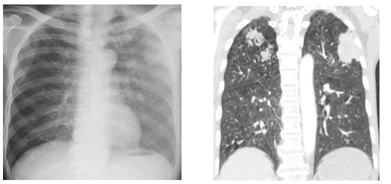 Hình ảnh phổi bệnh nhân bị tổn thương do ấu trùng giun lươn gây ra Hình ảnh phổi bệnh nhân bị tổn thương do ấu trùng giun lươn gây ra