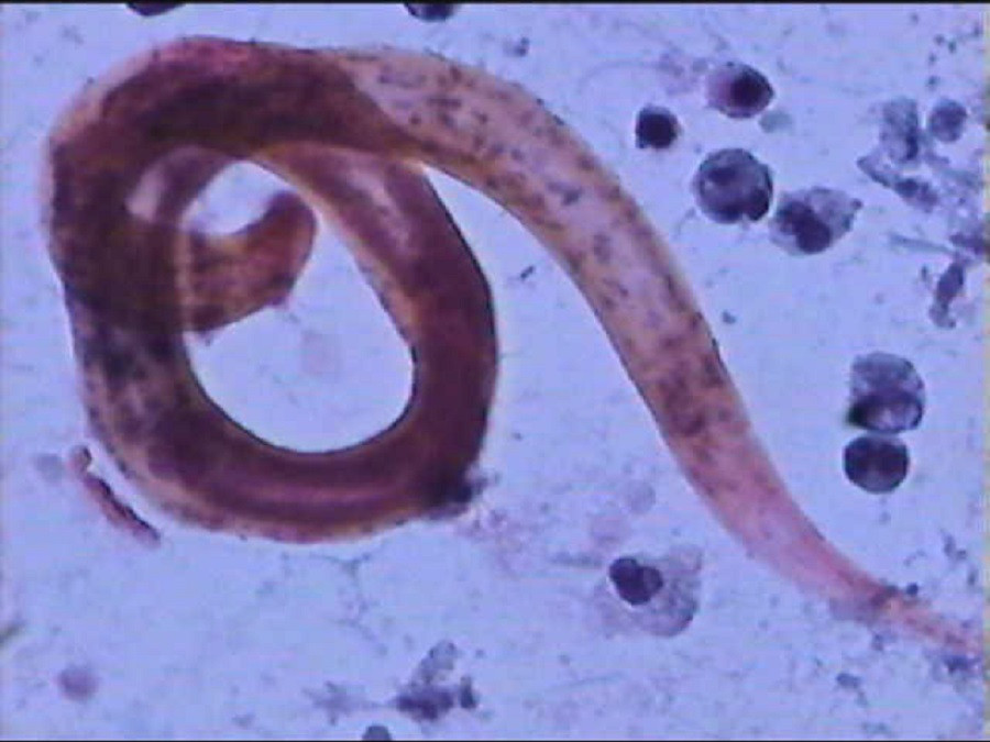 Ấu trùng giun lươn được rửa ra từ phổi bệnh nhân hiện nguyên hình trên kính hiển vi Ấu trùng giun lươn được rửa ra từ phổi bệnh nhân hiện nguyên hình trên kính hiển vi