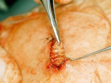 Ấu trùng của ruồi trâu xâm nhập vào da người sống ký sinh thông qua vết thương do côn trùng đốt. Ảnh: Health News Ấu trùng của ruồi trâu xâm nhập vào da người sống ký sinh thông qua vết thương do côn trùng đốt