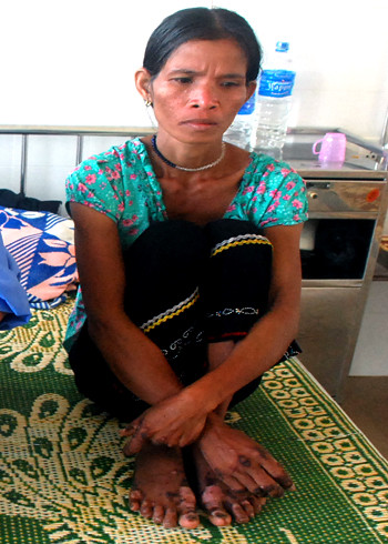 Bệnh nhân bị lở loét miệng, lòng bàn tay, bàn chân nổi lên các lớp vảy da dày giống vết bỏng