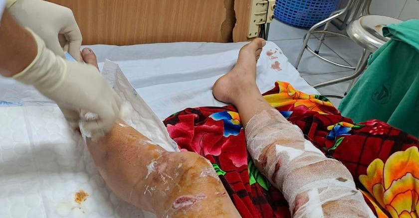 Nam sinh V. điều trị tại khoa Ngoại Bệnh viện Đa khoa Lào Cai. Nam sinh V. điều trị tại khoa Ngoại Bệnh viện Đa khoa Lào Cai.