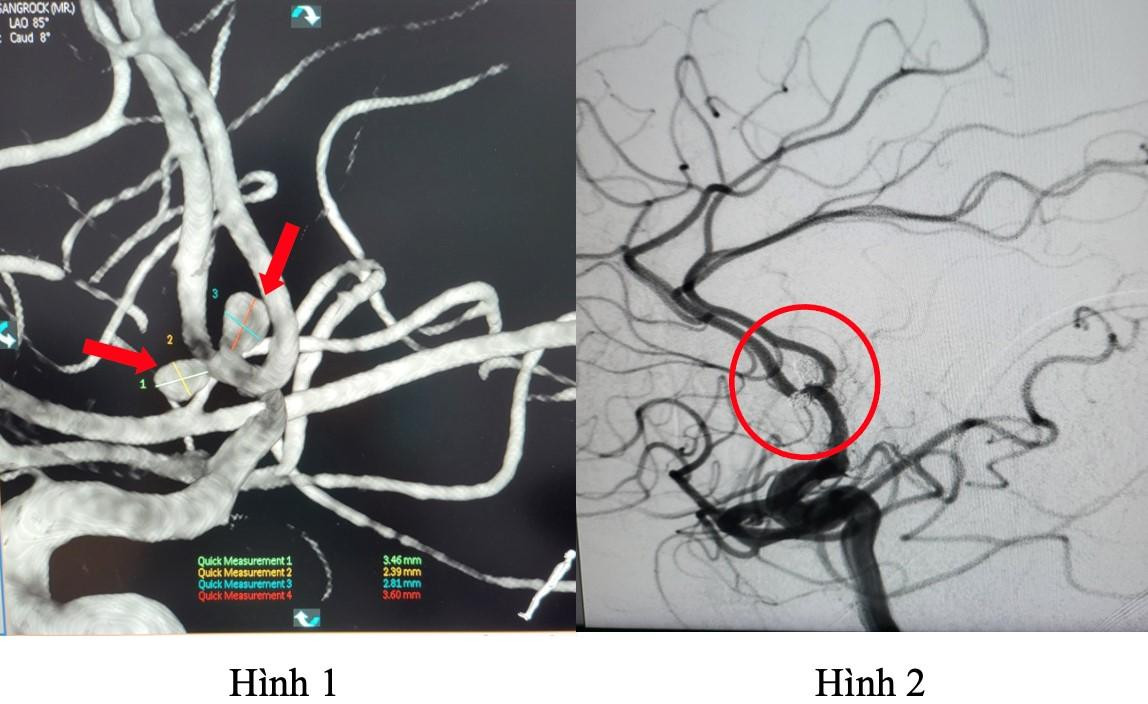 Hình ảnh 2 túi phình mạch máu não được phát hiện trước can thiệp (hình 1) và sau can thiệp (hình 2)