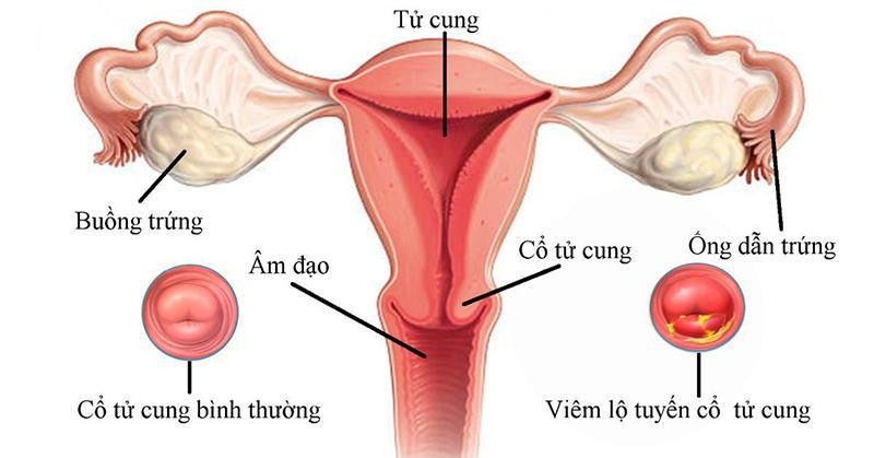 Viêm lộ tuyến cổ tử cung Viêm lộ tuyến cổ tử cung