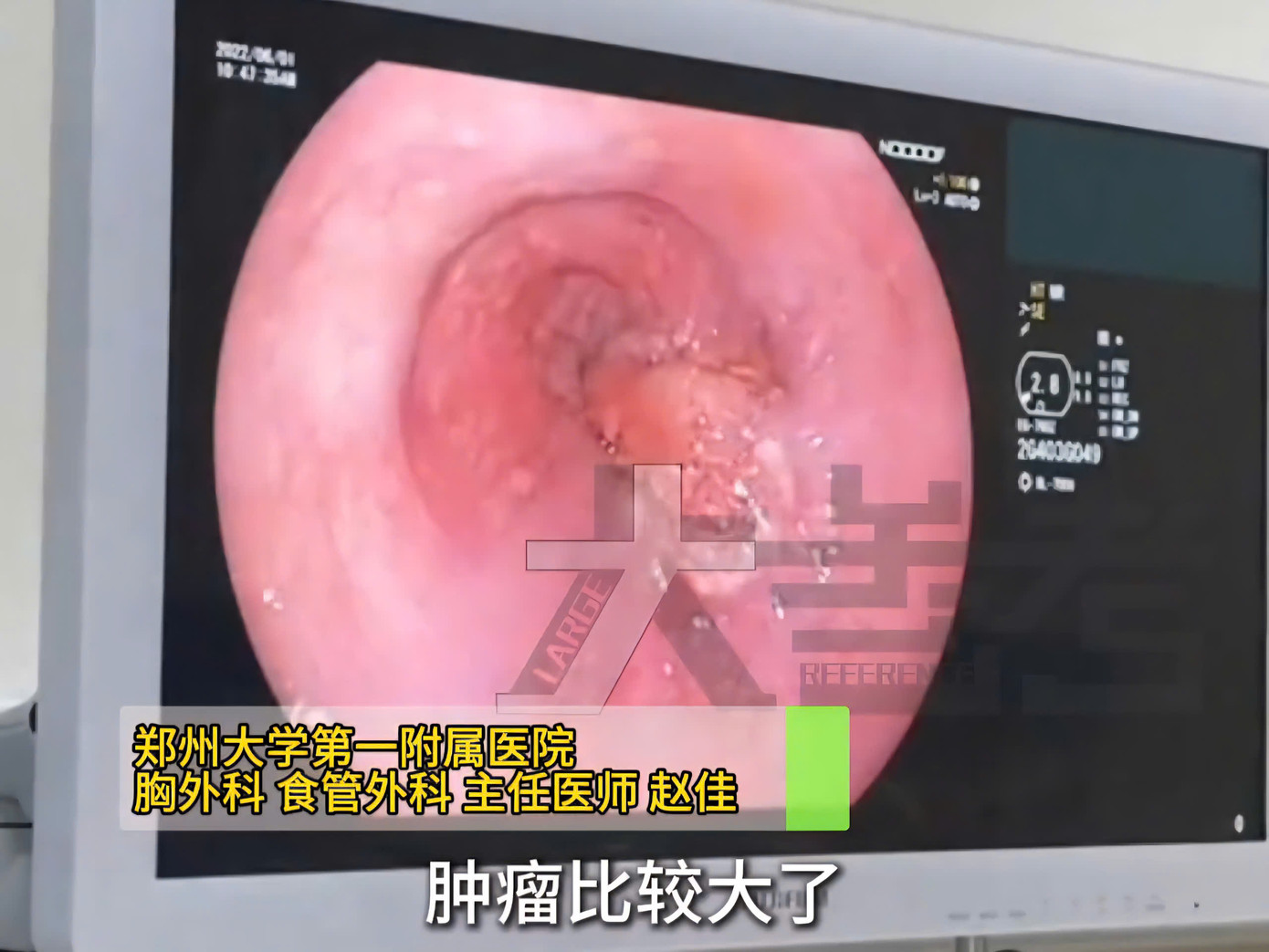 Hình ảnh nội soi thực quản của Tiểu Lý.