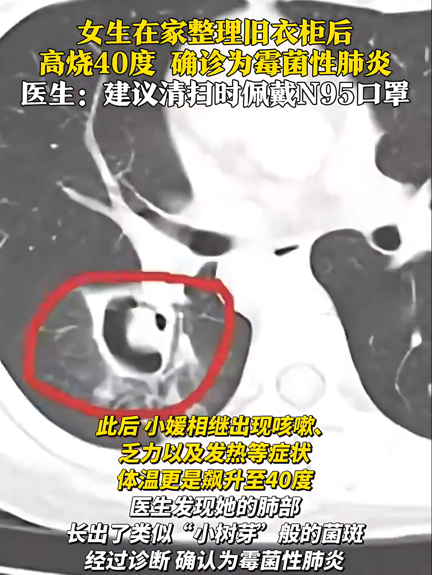 Bác sĩ chẩn đoán Tiểu Viên bị viêm phổi do nấm.