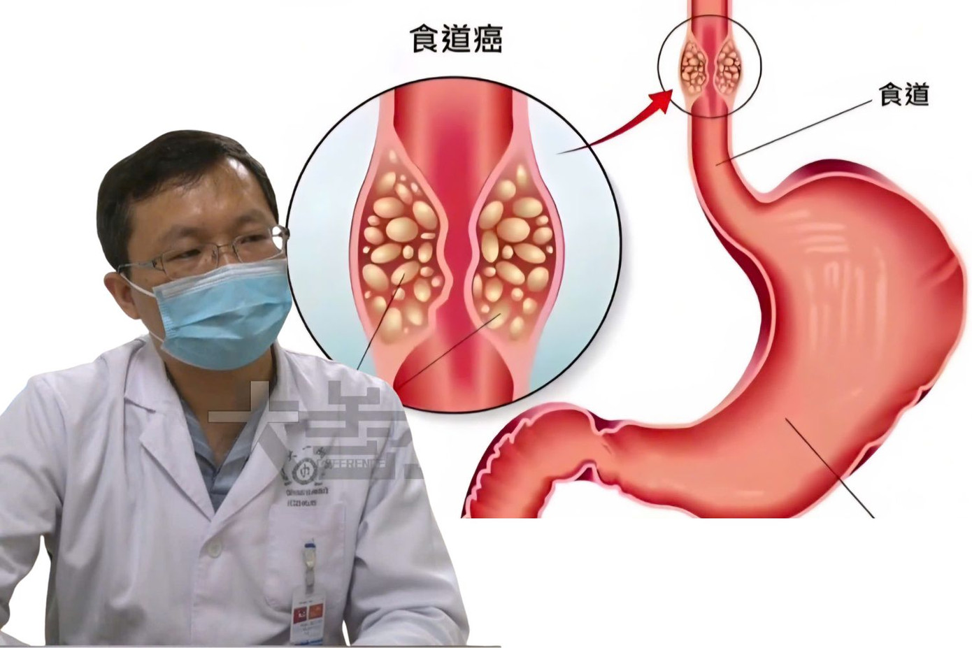 Ung thư thực quản giai đoạn đầu thường không có dấu hiệu rõ ràng, chỉ phát hiện khi người bệnh bắt đầu khó nuốt hoặc nghẹn.