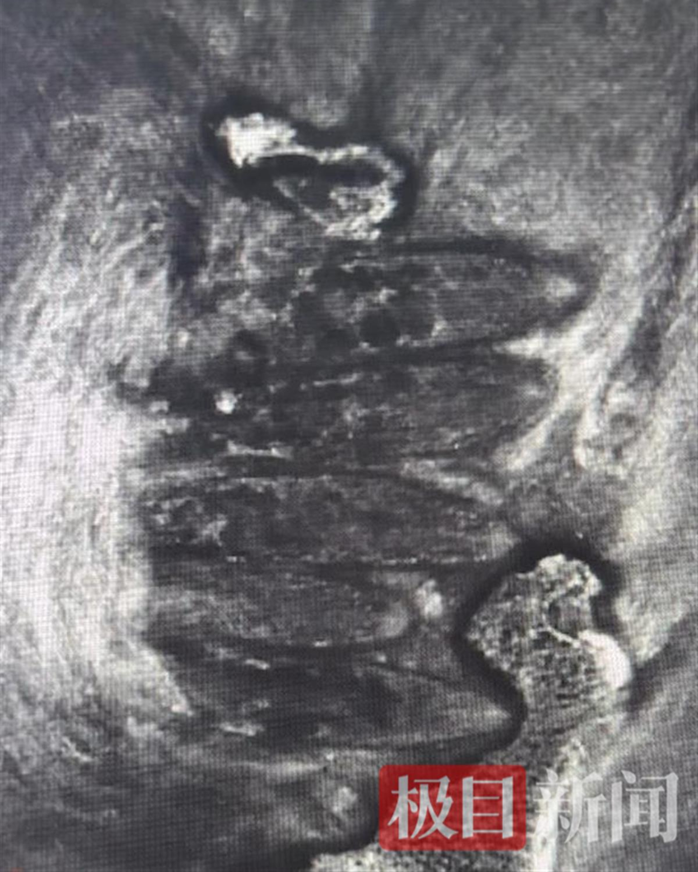 Bác sĩ Lưu Xuân Giang, Phó trưởng khoa tại Bệnh viện Mắt Ngãi Cách, sau khi kiểm tra đã phát hiện các lỗ tuyến Meibomian (tuyến nhờn ở mí mắt) của Tiểu Hạo bị tắc nghẽn hoàn toàn. Ảnh: Jimu News. Bác sĩ Lưu Xuân Giang, Phó trưởng khoa tại Bệnh viện Mắt Ngãi Cách, sau khi kiểm tra đã phát hiện các lỗ tuyến Meibomian (tuyến nhờn ở mí mắt) của Tiểu Hạo bị tắc nghẽn hoàn toàn. Ảnh: Jimu News.