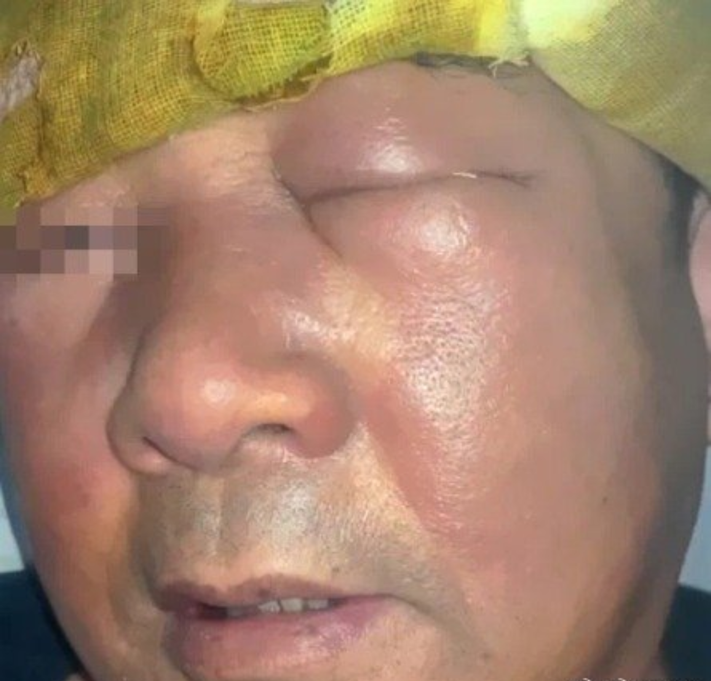 &quot;Ngoại cảm phong nhiệt thượng phạm&quot; được hiểu triệu chứng nóng sốt, viêm nhiễm vùng mặt theo lý giải của Đông y.