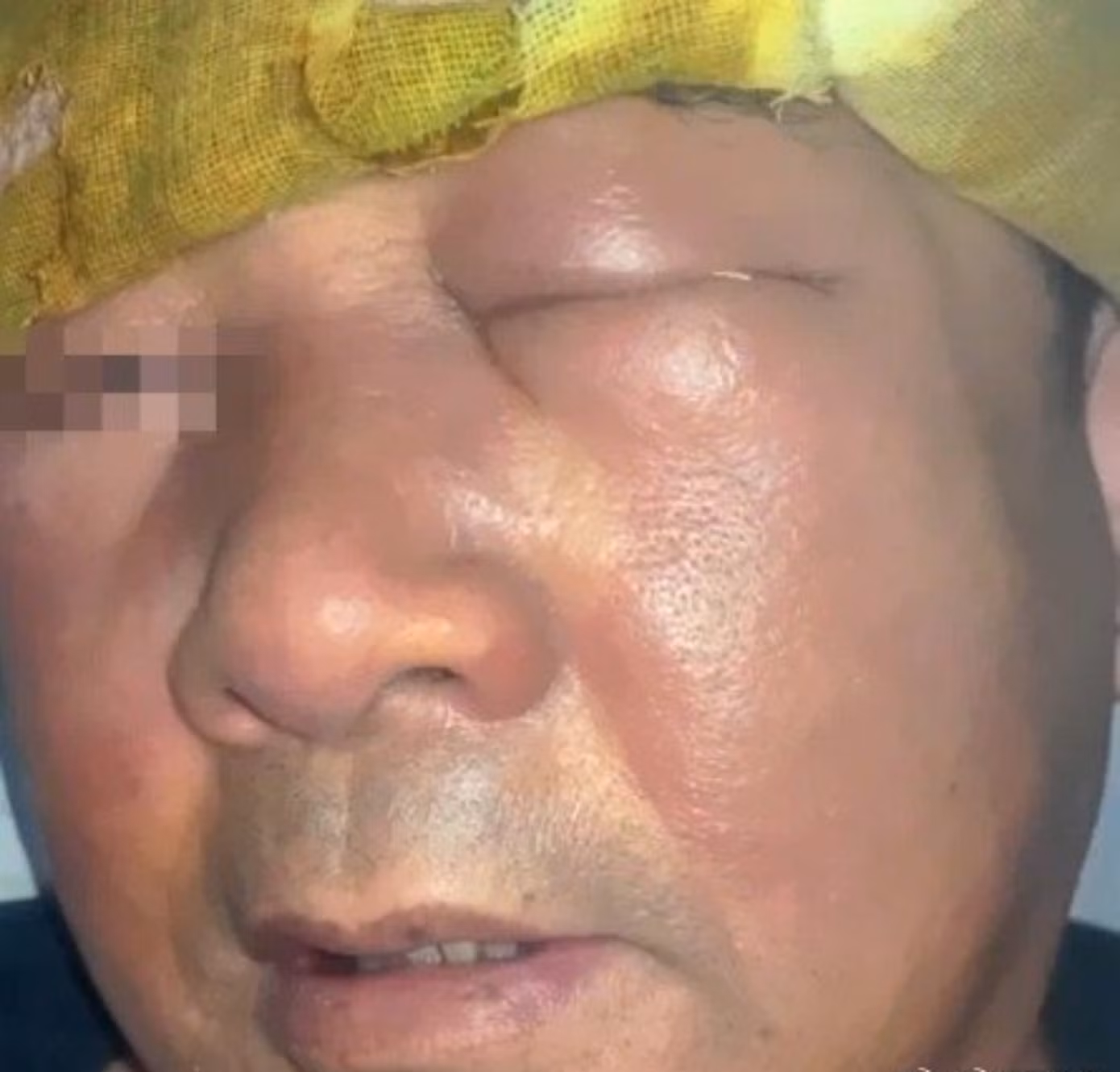 "Ngoại cảm phong nhiệt thượng phạm" được hiểu triệu chứng nóng sốt, viêm nhiễm vùng mặt theo lý giải của Đông y.