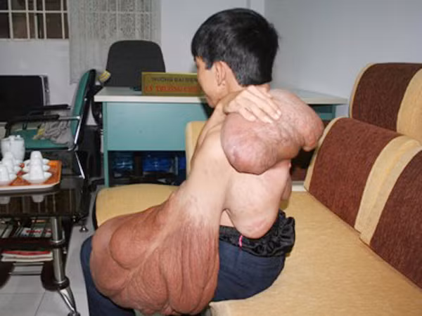 Ngoài cánh tay khổng lồ Vũ còn mang thêm 3 tảng thịt thừa trên lưng. Ngoài cánh tay khổng lồ Vũ còn mang thêm 3 tảng thịt thừa trên lưng