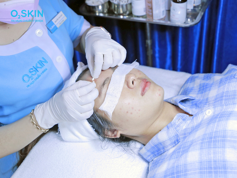 Điều dưỡng O2 SKIN đang thực hiện lấy nhân mụn cho khách hàng.
