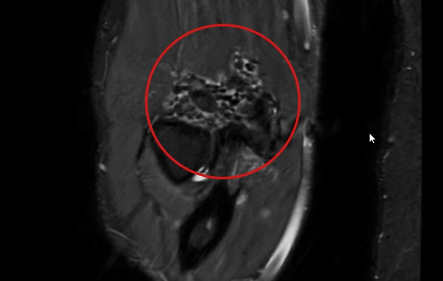 Hình ảnh 50 viên sụn lấp đầy khớp khuỷu tay theo kết quả chụp MRI