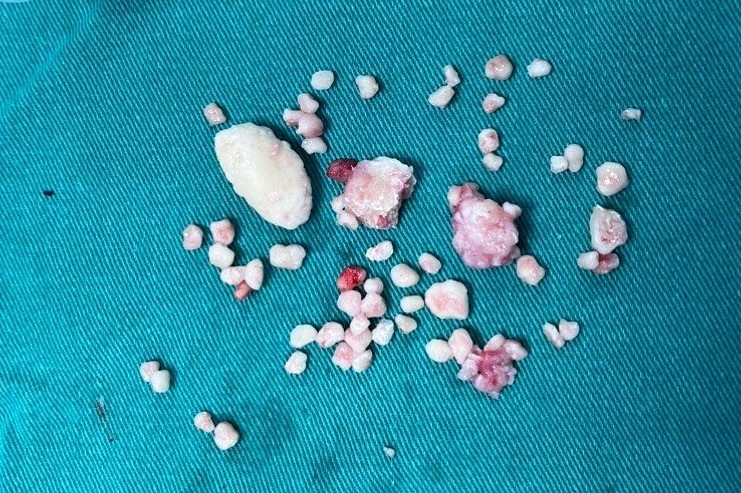 50 viên sụn xương đã được loại bỏ hoàn toàn ra khỏi khớp khuỷu tay của bệnh nhân