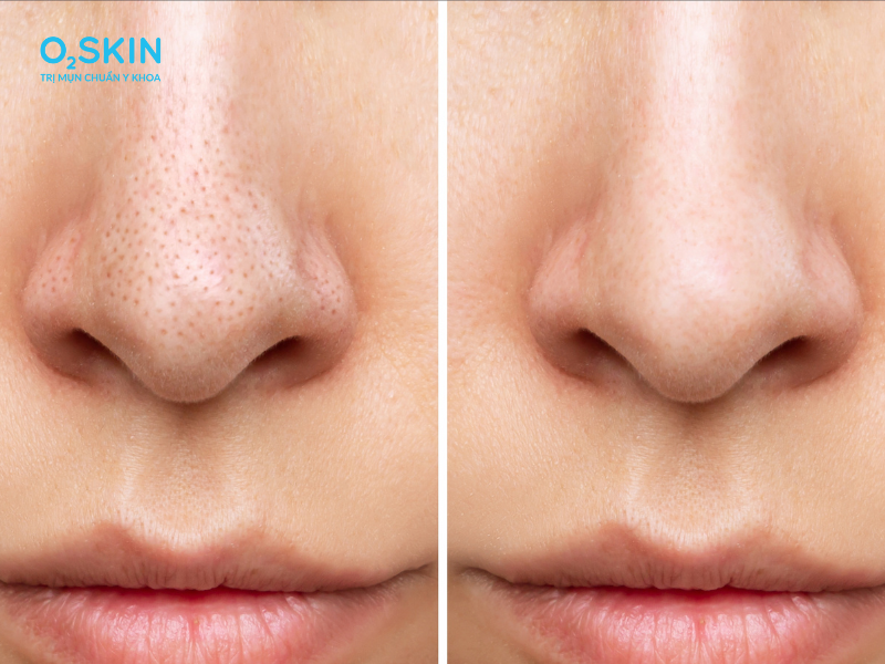 Chăm sóc da đúng cách giúp hạn chế bít tắc lỗ chân lông và cải thiện mụn đầu đen.