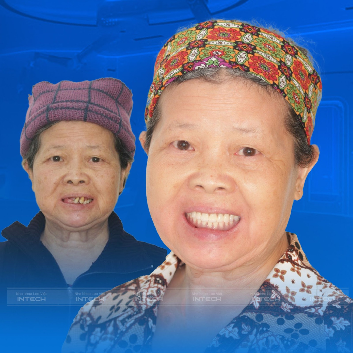 Cô Trần Thị Bộ với nụ cười tự tin sau khi trồng răng implant