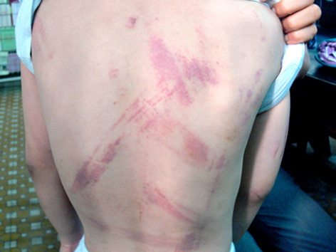 Vết roi trên lưng cậu bé 7 tuổi. Ảnh: VnExpress. Vết roi trên lưng cậu bé 7 tuổi. Ảnh: VnExpress