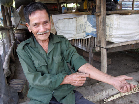 Vết sẹo mà tên giang hồ ở chợ Cầu Muối đã chém ông. Ảnh: An Nhơn