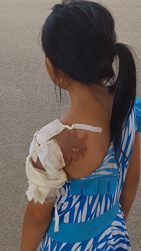 Vợ tạt nước sôi khiến chồng nguy kịch, con bị thương ảnh 1