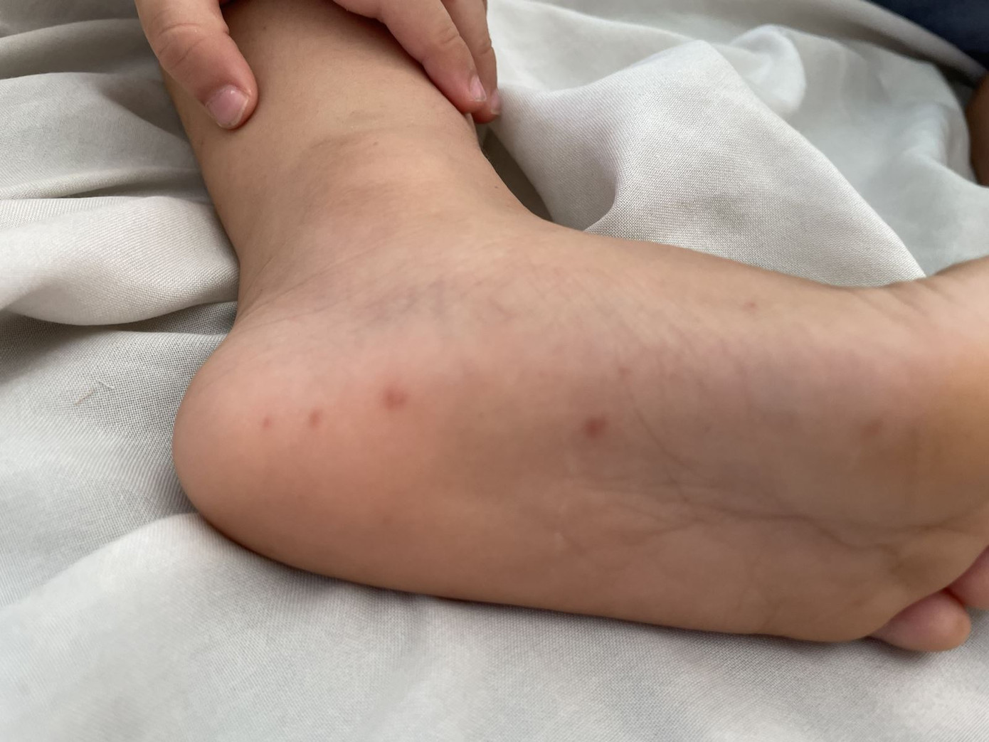 Trẻ bị tay chân miệng thường xuất hiện các nốt hồng ban ở lòng bàn chân, tay.