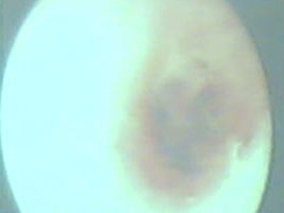 Tổ kiến nằm gọn trong tai phải của cô bé. Ảnh: Chilli