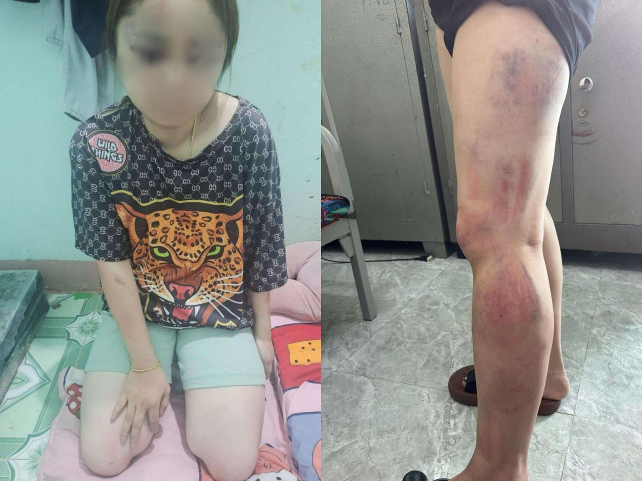 Nạn nhân bị hành hung nhiều bộ phận như mặt, chân, lưng